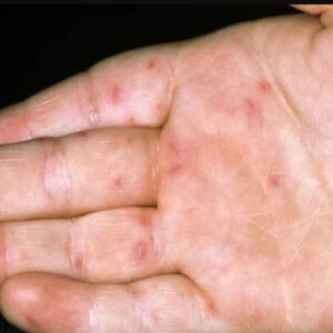 Creștere alarmantă a unui virus extrem de contagios în mai multe state americane