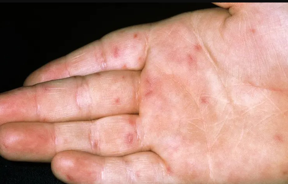 Creștere alarmantă a unui virus extrem de contagios în mai multe state americane